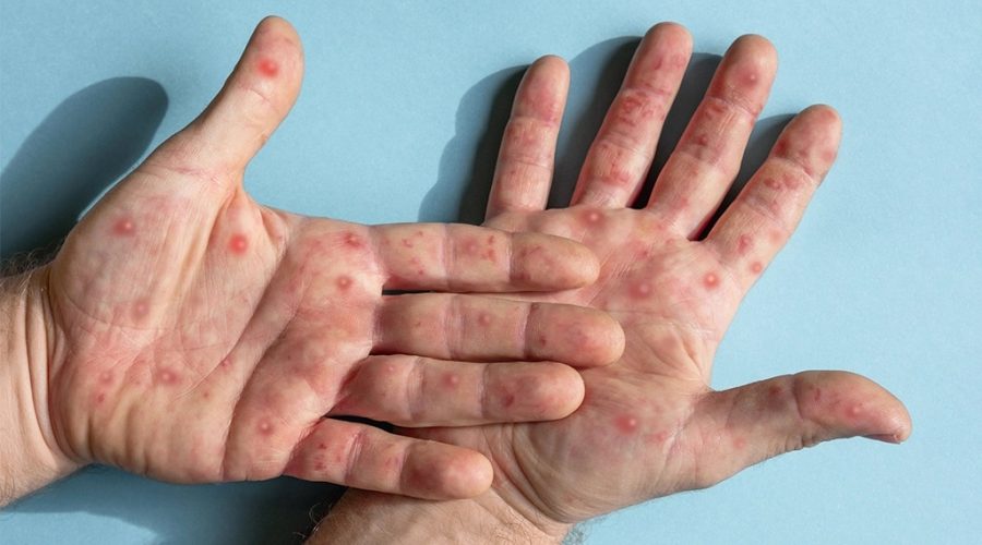 Jundiaí registra primeiro caso de mpox em 2026 e reforça alerta à população